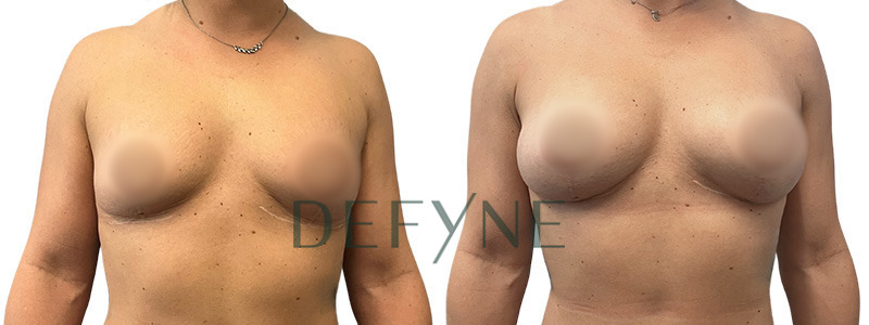 The True Shape Breast Augmentation 2 Combined Image