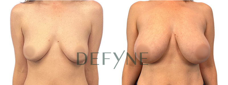 The True Shape Breast Augmentation 1 Combined Image