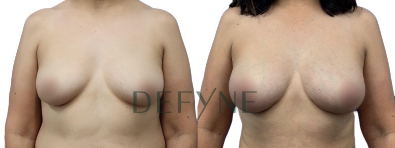 The True Shape Breast Augmentation 3 Combined Image