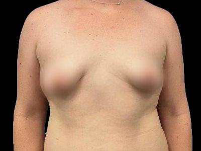 Before — Breast Augmentation with Implants, Patient #58209