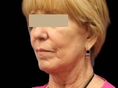 After — Facelift, Patient #99649
