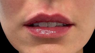 After — Fillers, Patient #79571