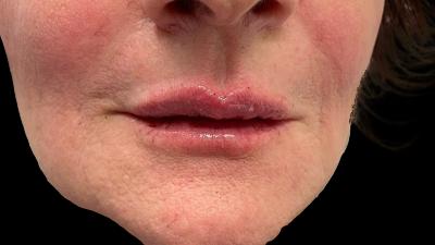 After — Fillers, Patient #22841