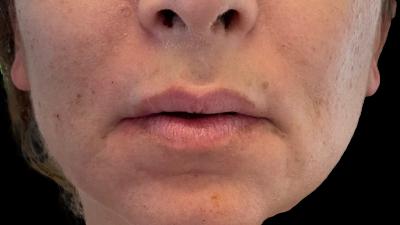 Before — Fillers, Patient #39271