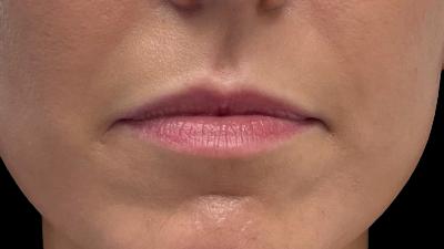 Before — Fillers, Patient #79571