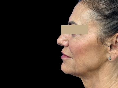 Before — ReGen Dermacore, Patient #33471