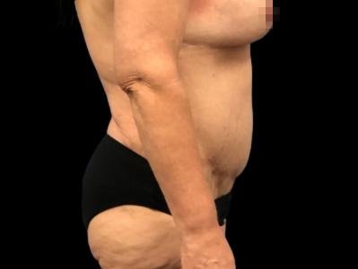 After — Tummy Tuck, Patient #96569, view 3