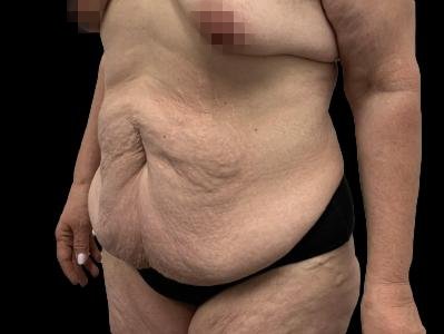 Before — Tummy Tuck, Patient #96569, view 2