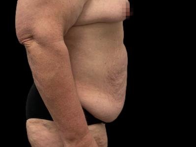 Before — Tummy Tuck, Patient #96569, view 3