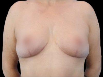 After — Breast Lift, Patient #84642, view 1