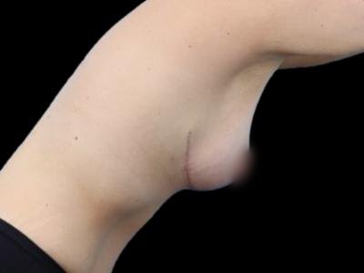 After — Breast Lift, Patient #84642, view 3