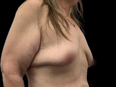 Before — Breast Lift, Patient #56213, view 3