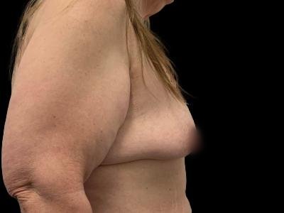 Before — Breast Lift, Patient #56213, view 1