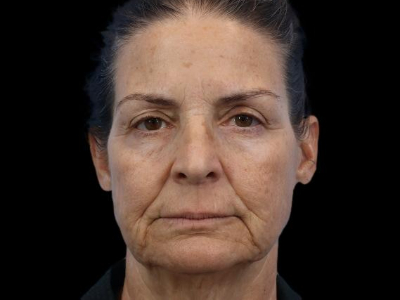 Before — Facelift, Patient #20066