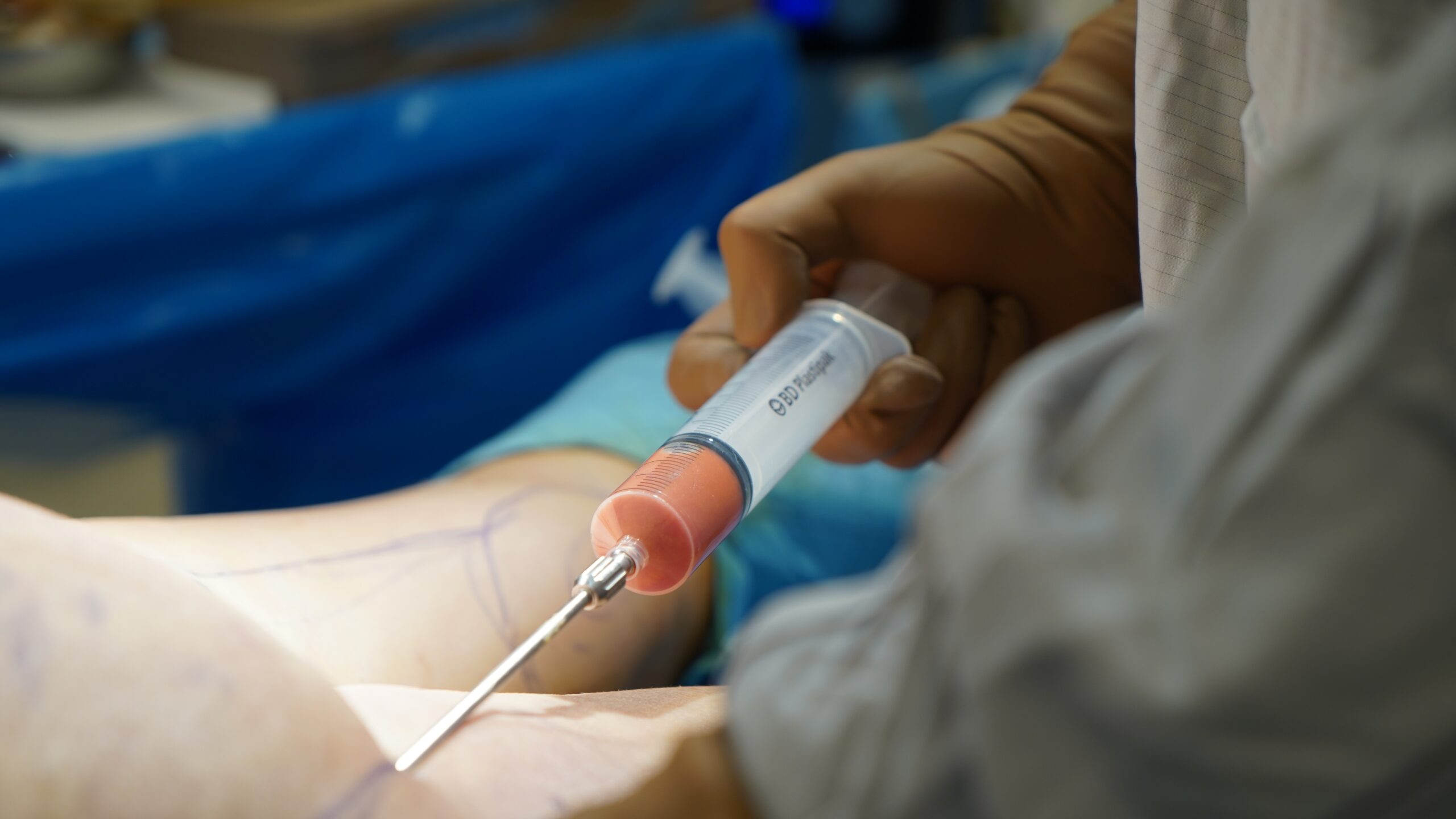 Latest Advancements in Fat Grafting