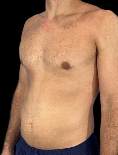 After — Gynecomastia Reduction, Patient #37185, view 2