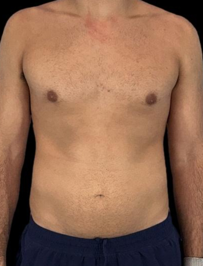 After — Gynecomastia Reduction, Patient #37185, view 3