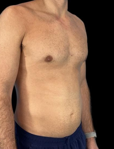 After — Gynecomastia Reduction, Patient #37185