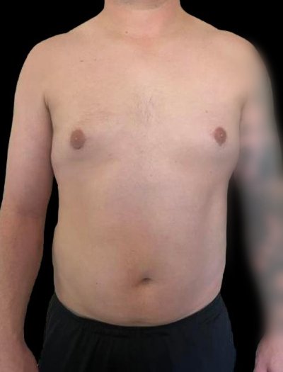 After — Gynecomastia Reduction, Patient #37184