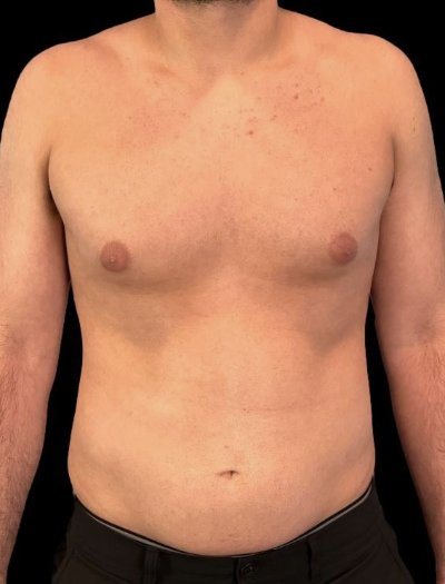 Before — Gynecomastia Reduction, Patient #37185, view 3