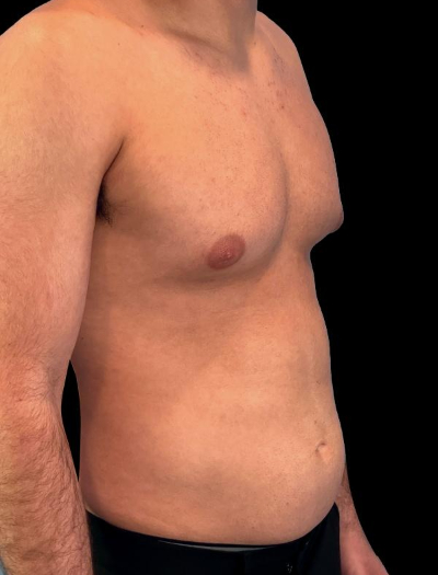 Before — Gynecomastia Reduction, Patient #37185