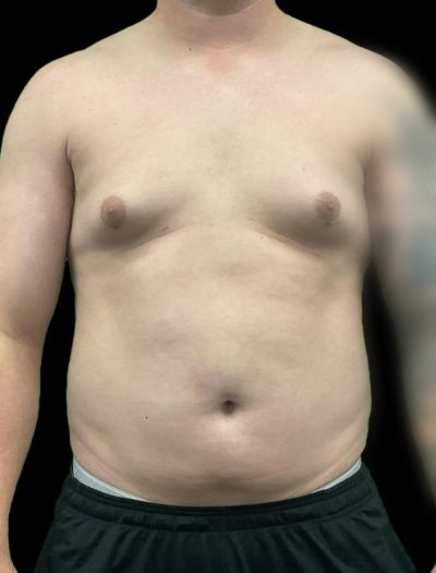Before — Gynecomastia Reduction, Patient #37184