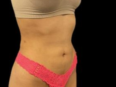 After — S.M.A.R.T. Tummy Tuck, Patient #68062, view 2