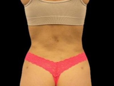 After — S.M.A.R.T. Tummy Tuck, Patient #68062, view 3