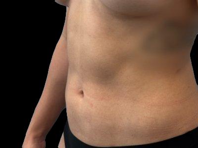 After — S.M.A.R.T. Tummy Tuck, Patient #72807