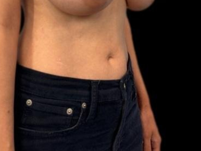 After — S.M.A.R.T. Tummy Tuck, Patient #29416, view 2