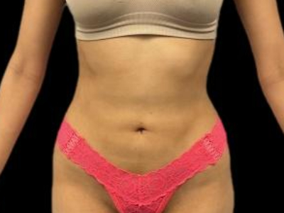 After — S.M.A.R.T. Tummy Tuck, Patient #68062