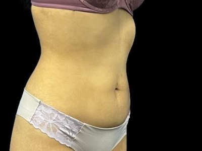 Before — S.M.A.R.T. Tummy Tuck, Patient #68062, view 2
