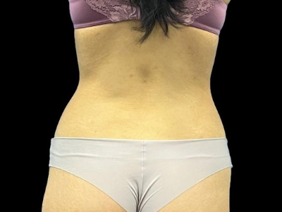 Before — S.M.A.R.T. Tummy Tuck, Patient #68062, view 3