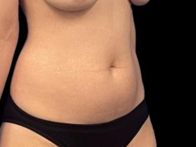 Before — S.M.A.R.T. Tummy Tuck, Patient #29416, view 2