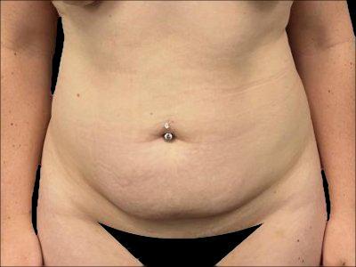 Before — S.M.A.R.T. Tummy Tuck, Patient #15520