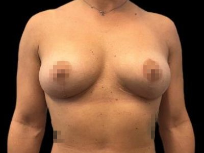 After — Breast Augmentation with Fat Grafting (True Shape), Patient #75828