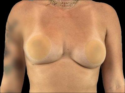 After — Breast Augmentation with Fat Grafting (True Shape), Patient #71860