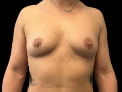 Before — Breast Augmentation with Fat Grafting (True Shape), Patient #75828