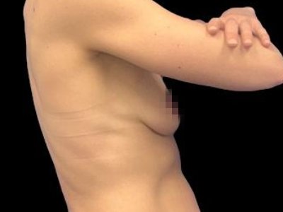 Before — Breast Augmentation with Fat Grafting (True Shape), Patient #15388
