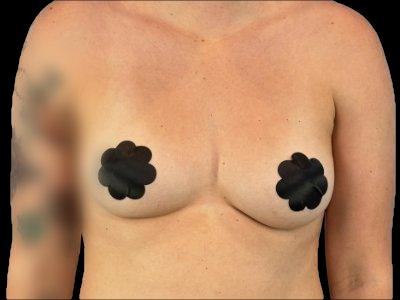Before — Breast Augmentation with Fat Grafting (True Shape), Patient #71860