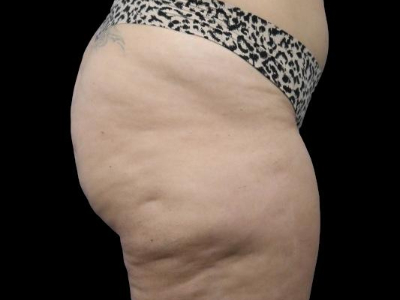 Before — True Curve BBL, Patient #21035, view 2