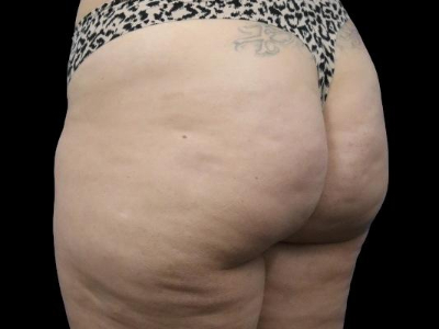 Before — True Curve BBL, Patient #21035, view 3