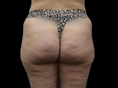 Before — True Curve BBL, Patient #21035, view 4