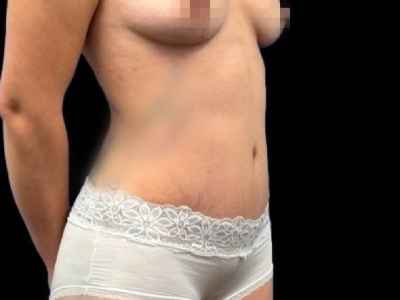 After — Tummy Tuck, Patient #11643, view 2