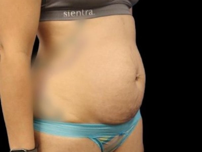 Before — Tummy Tuck, Patient #11643, view 2
