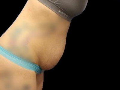Before — Tummy Tuck, Patient #11643, view 3