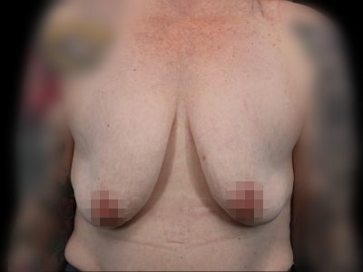 Before — Breast Augmentation with Implants, Patient #106998