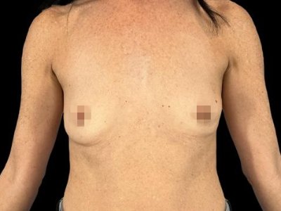 Before — Breast Augmentation with Implants, Patient #53462