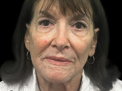 Before — Facelift, Patient #101579