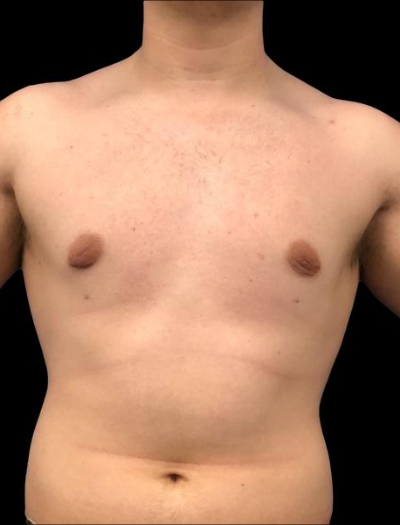 After — Gynecomastia Reduction, Patient #45563